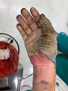 burned hand