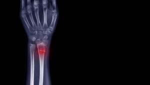 wrist fracture